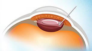 ICL晶体植入手术：高度近视的选择！