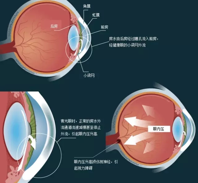 各类型青光眼治疗原则